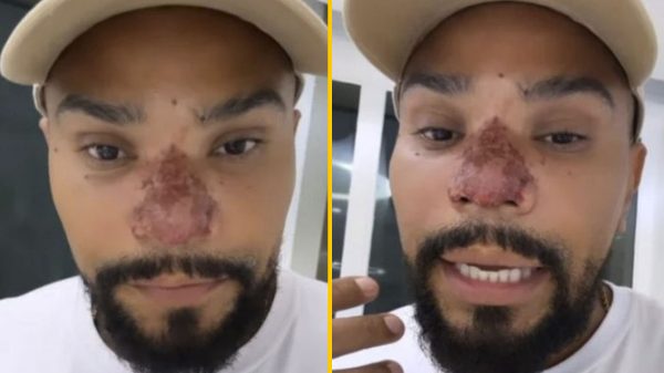 Naldo Benny fez cirurgia malsucedida no nariz e mostrou resultado aos fãs (Montagem/Instagram)